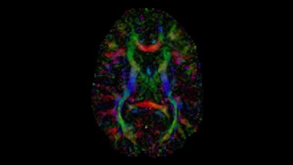axial slice of a diffusion tensor image